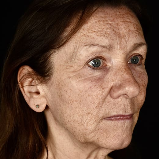 Before full laser skin resurfacing, addressing fine lines and wrinkles in the lower cheek.