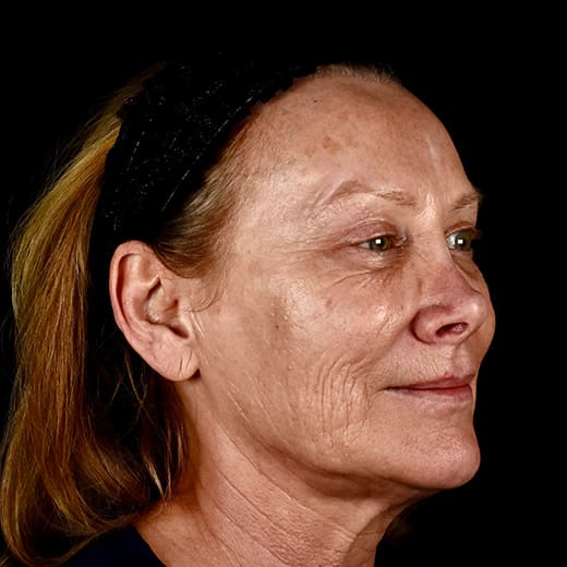 Before full laser skin resurfacing, addressing lower cheek wrinkles and rough skin.