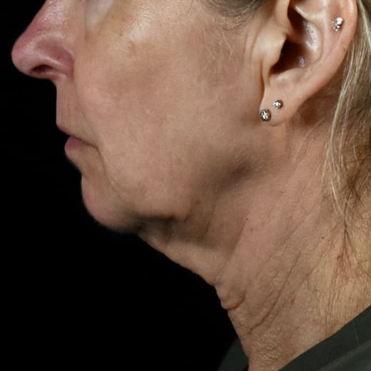 Before jowl lift with chin and jaw filler, addressing sagging neck and sagging jawline