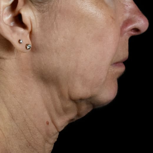 Before jowl lift with chin and jaw filler, addressing sagging neck and sagging jawline