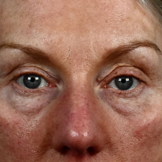Before laser eye lift and filler treatment, addressing volume loss and under-eye bags.