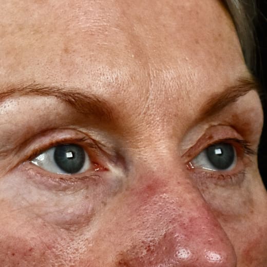 Before laser eye lift and filler treatment, addressing volume loss and under-eye bags.