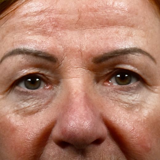 Before laser eye lift, addressing under-eye bags.