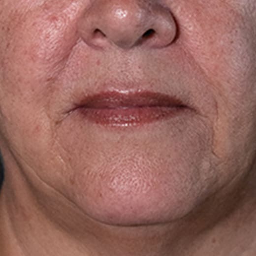 Before lip and cheek filler, addressing lipstick / smokers' lines.