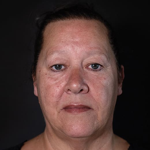 Before lip and cheek filler, addressing lipstick / smokers' lines.