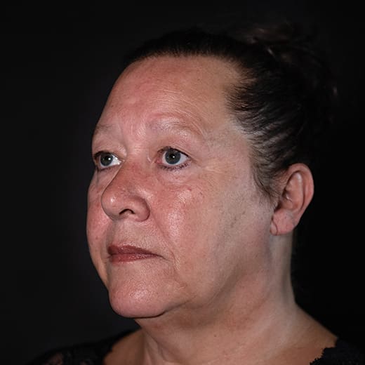 Before lip and cheek filler, addressing lipstick / smokers' lines.