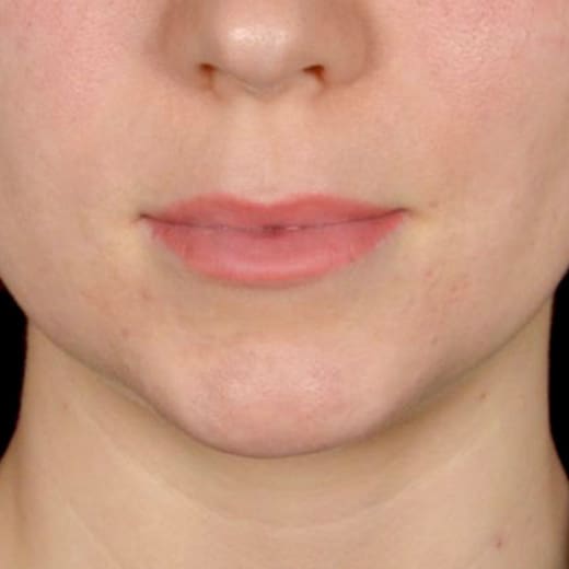 Before lip lift, addressing a long upper lip