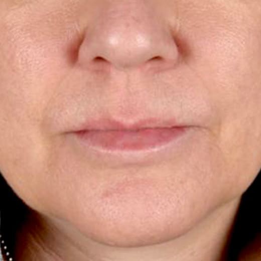 Before lip lift, addressing a long upper lip