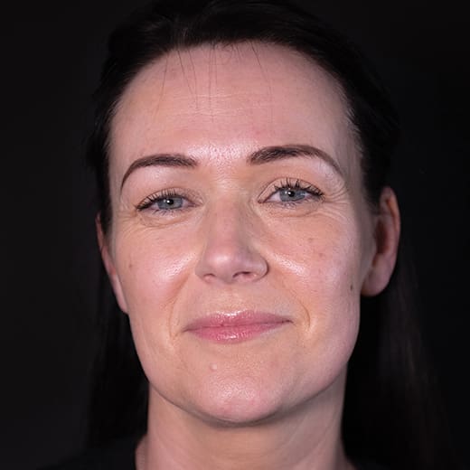 Before non-surgical eye lift with wrinkle-relaxing injections, addressing heavy upper eyelids.