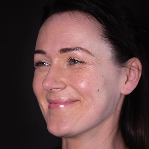 Before non-surgical eye lift with wrinkle-relaxing injections, addressing heavy upper eyelids.