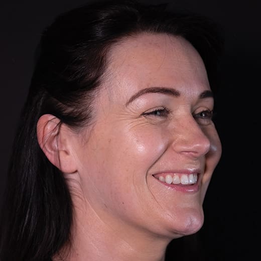 Before non-surgical eye lift with wrinkle-relaxing injections, addressing heavy upper eyelids.