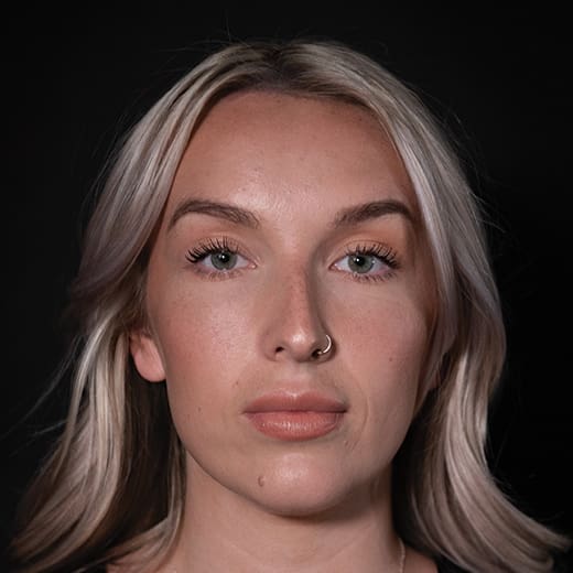 Before non-surgical rhinoplasty with chin and jaw filler, to address a prominent nose and imbalanced chin projection.