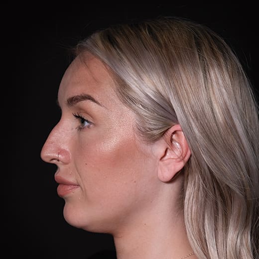 Before non-surgical rhinoplasty with chin and jaw filler, to address a prominent nose and imbalanced chin projection.