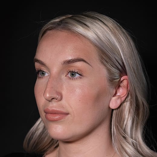 Before non-surgical rhinoplasty with chin and jaw filler, to address a prominent nose and imbalanced chin projection.