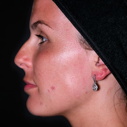 Before non-surgical rhinoplasty with nose contouring, addressing a nose bump