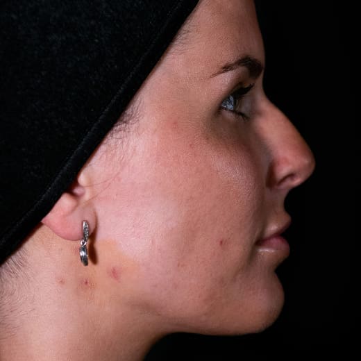 Before non-surgical rhinoplasty with nose contouring, addressing a nose bump