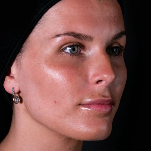 Before non-surgical rhinoplasty with nose contouring, addressing a nose bump