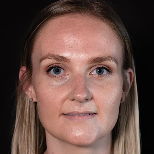 Before tear trough filler, addressing dark circles under the eyes.