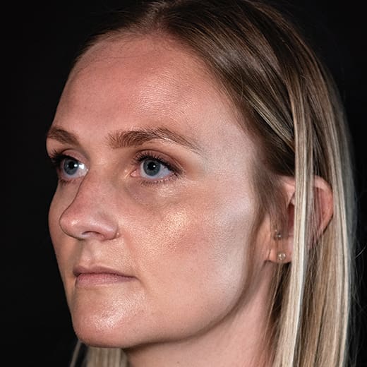 Before tear trough filler, addressing dark circles under the eyes.