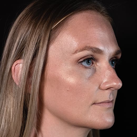 Before tear trough filler, addressing dark circles under the eyes.