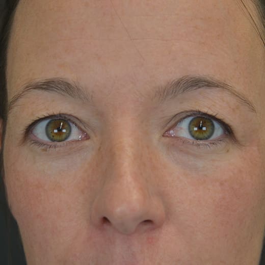 Before upper blepharoplasty (eyelid surgery), addressing heavy upper eyelids