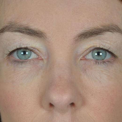 Before upper blepharoplasty (eyelid surgery), addressing heavy upper eyelids