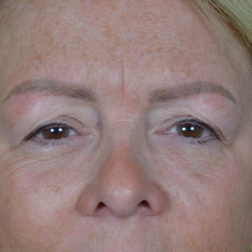 Before upper blepharoplasty (eyelid surgery), addressing heavy upper eyelids