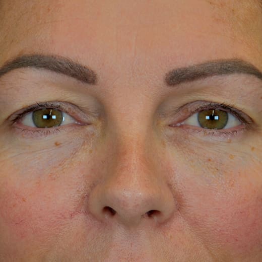 Before upper blepharoplasty (upper eyelid surgery), addressing heavy upper eyelids.