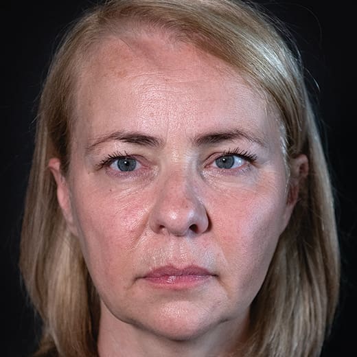 Before volumetric facelift with cheek, chin, and jawline filler, addressing jowls.