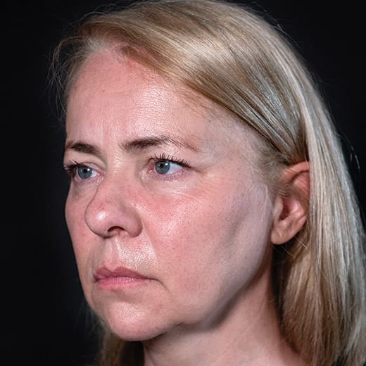 Before volumetric facelift with cheek, chin, and jawline filler, addressing jowls.