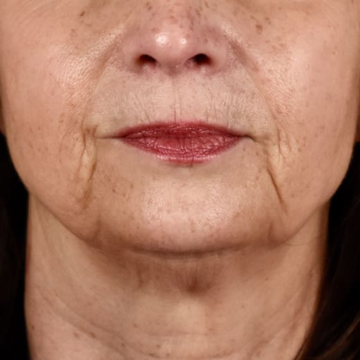 Before a volumetric facelift with cheek filler, addressing marionette lines.