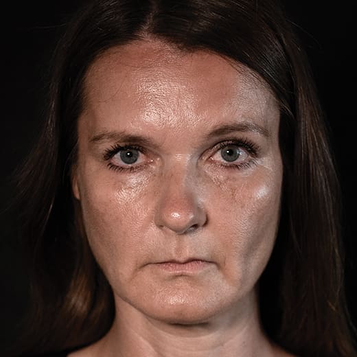 Before volumetric facelift with chin and jaw filler, addressing downturned mouth corners