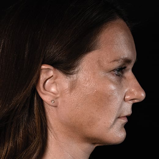 Before volumetric facelift with chin and jaw filler, addressing downturned mouth corners