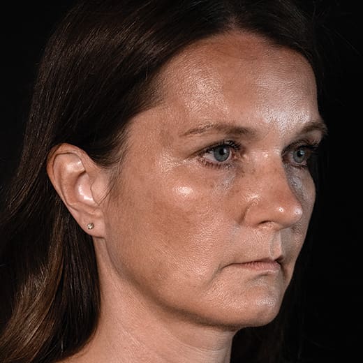 Before volumetric facelift with chin and jaw filler, addressing downturned mouth corners