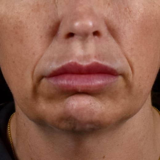 Before volumetric facelift with chin and jaw fillers, chin augmentation, and jowl lift, addressing sagging neck and sagging jawline.