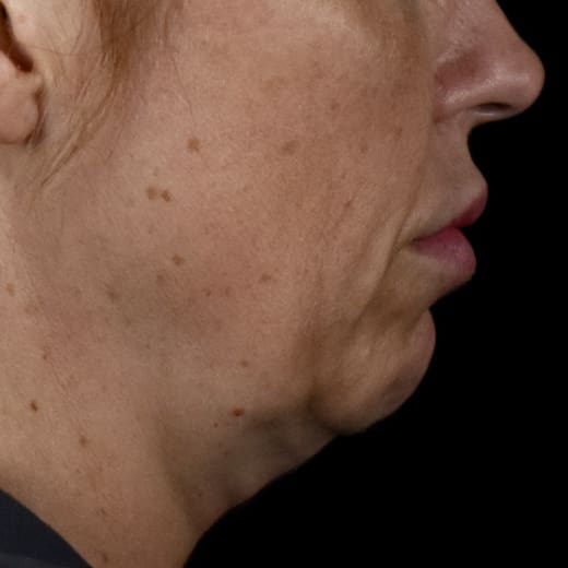 Before volumetric facelift with chin and jaw fillers, chin augmentation, and jowl lift, addressing sagging neck and sagging jawline.