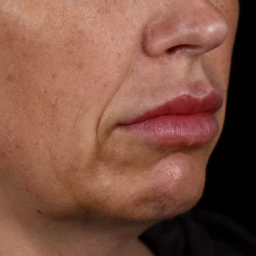 Before volumetric facelift with chin and jaw fillers, chin augmentation, and jowl lift, addressing sagging neck and sagging jawline.