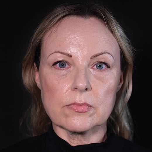 Before a volumetric facelift with jowl lift, chin augmentation, and tear trough filler, addressing sagging jawline, jowls, under-eye bags, and dark circles