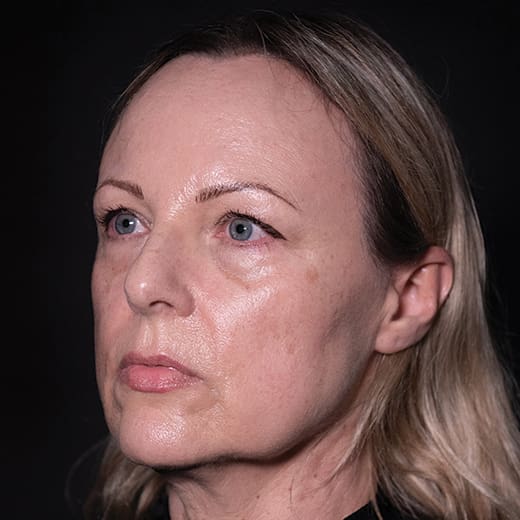 Before a volumetric facelift with jowl lift, chin augmentation, and tear trough filler, addressing sagging jawline, jowls, under-eye bags, and dark circles