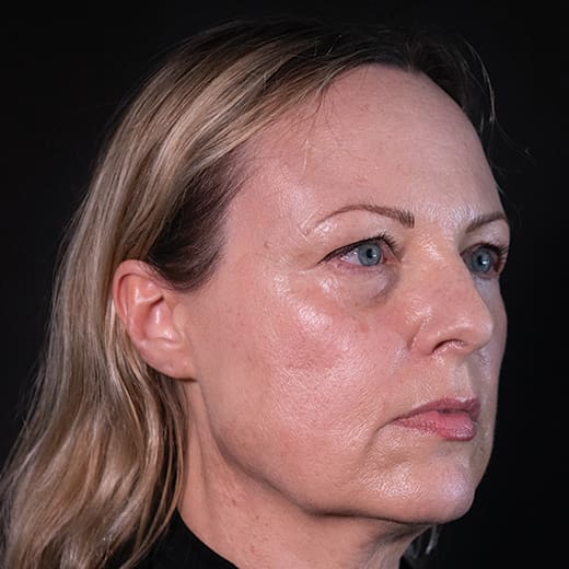 Before a volumetric facelift with jowl lift, chin augmentation, and tear trough filler, addressing sagging jawline, jowls, under-eye bags, and dark circles