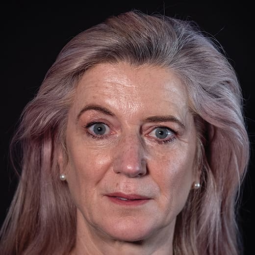 Before volumetric facelift with jowl lift and chin, jaw, and cheek filler, addressing sagging cheeks and sagging jawline.