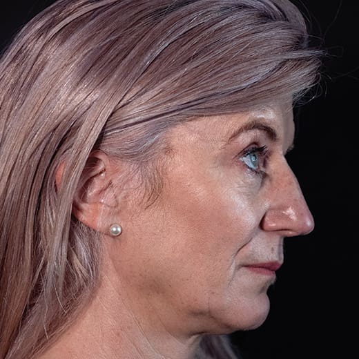 Before volumetric facelift with jowl lift and chin, jaw, and cheek filler, addressing sagging cheeks and sagging jawline.