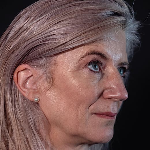 Before volumetric facelift with jowl lift and chin, jaw, and cheek filler, addressing sagging cheeks and sagging jawline.
