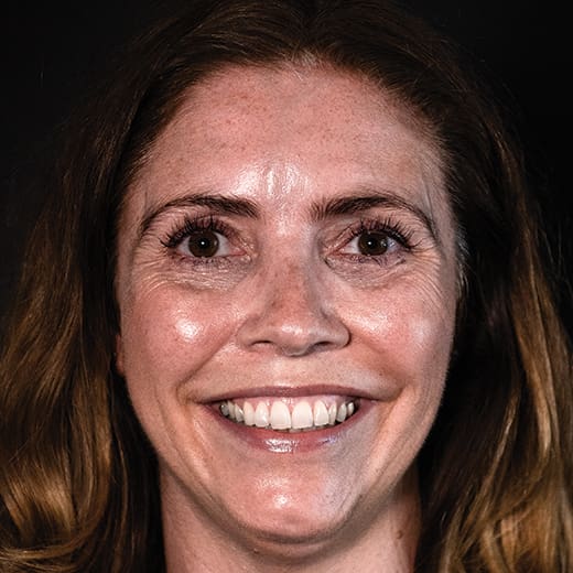 Before wrinkle-relaxing injections and filler, addressing crow's feet.