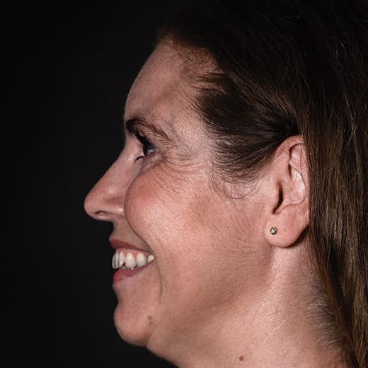 Before wrinkle-relaxing injections and filler, addressing crow's feet.