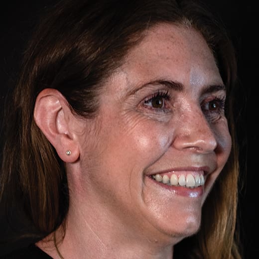 Before wrinkle-relaxing injections and filler, addressing crow's feet.