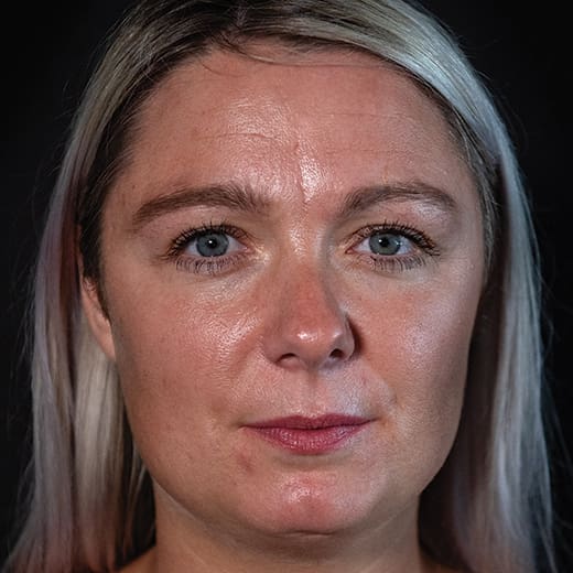 Before wrinkle-relaxing injections and fillers, addressing frown lines.