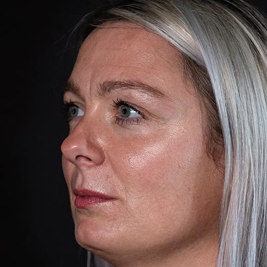 Before wrinkle-relaxing injections and fillers, addressing frown lines.