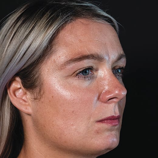 Before wrinkle-relaxing injections and fillers, addressing frown lines.