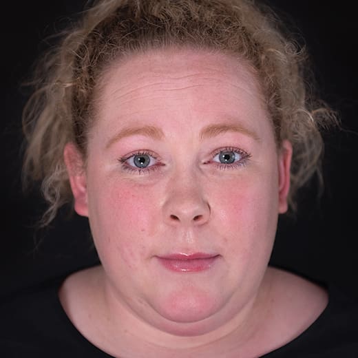 Before wrinkle-relaxing injections, addressing forehead lines.